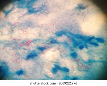 Detail Gambar Bakteri Mycobacterium Tuberculosis Nomer 52