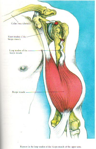 Detail Cedera Otot Lengan Nomer 42