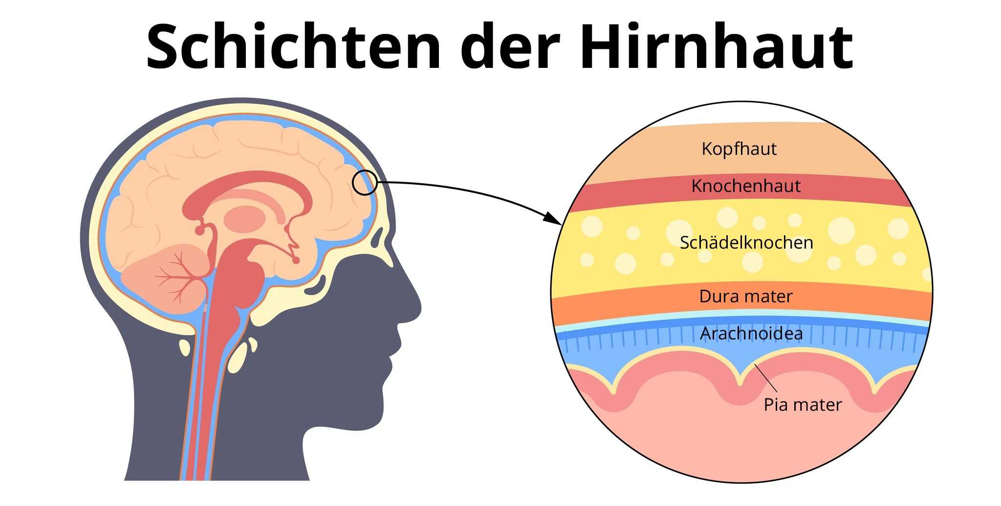 Hirnblutung Bilder - KibrisPDR