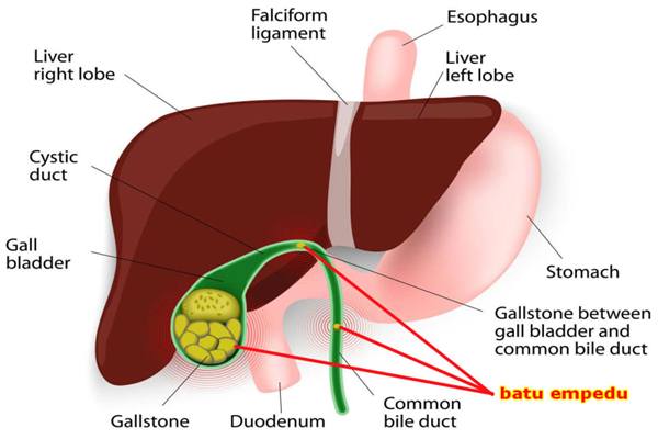 Detail Gambar Batu Empedu Nomer 9