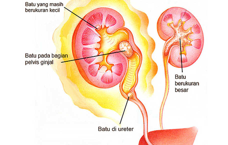 Detail Gambar Batu Ginjal Nomer 30