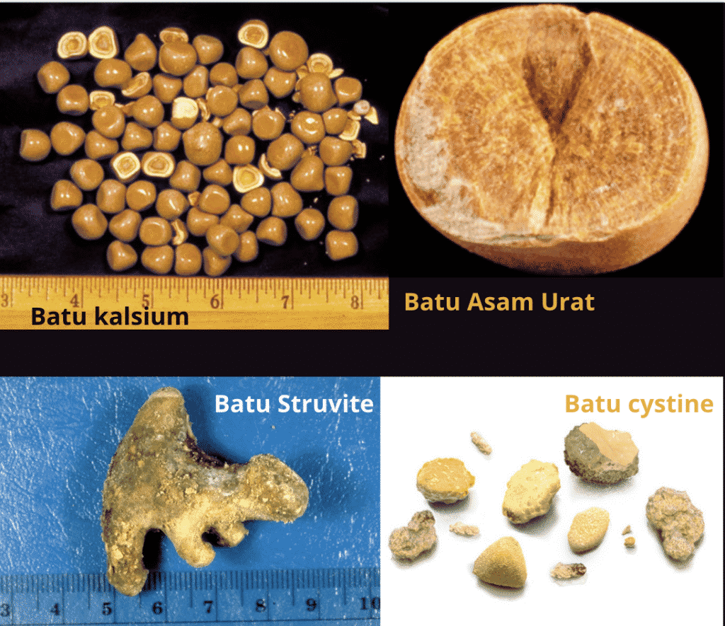 Detail Gambar Batu Ginjal Yang Keluar Nomer 16