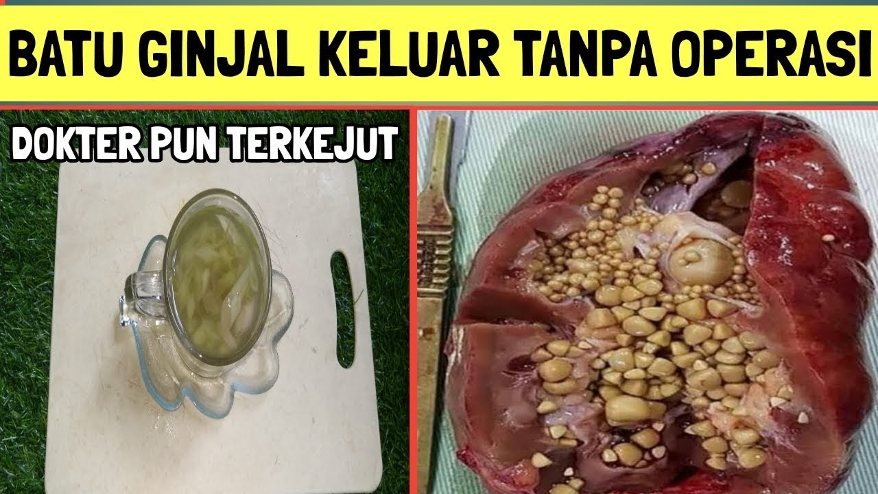 Detail Gambar Batu Ginjal Yang Keluar Nomer 40