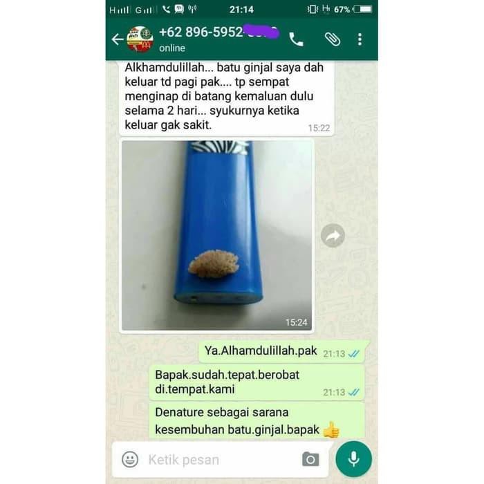 Detail Gambar Batu Ginjal Yang Keluar Nomer 49