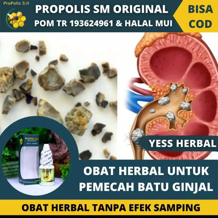 Detail Gambar Batu Ginjal Yang Keluar Nomer 50