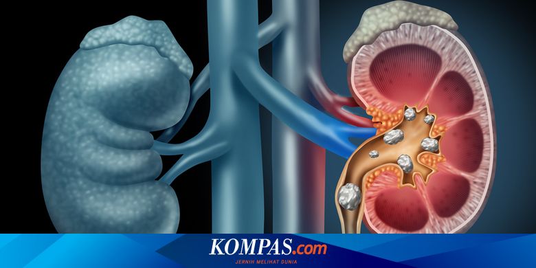 Detail Gambar Batu Kecil Keluar Dari Kemaluan Laki Laki Nomer 25