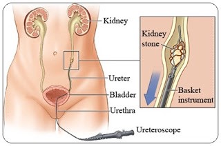 Detail Gambar Batu Saluran Kemih Nomer 27