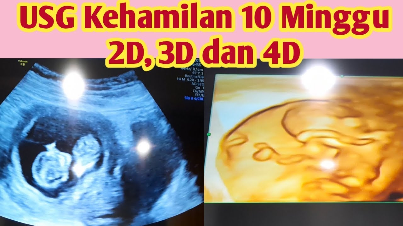 Detail Gambar Bayi 10 Minggu Nomer 14