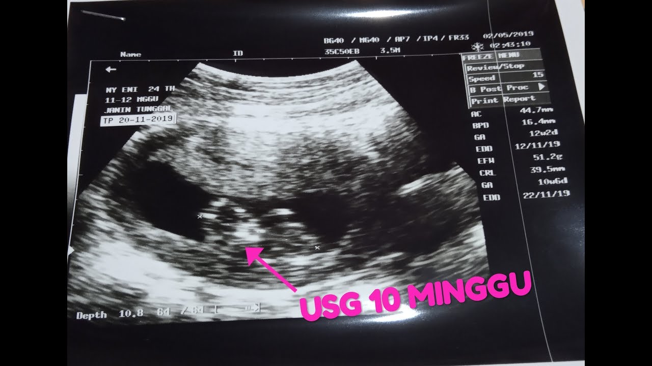 Detail Gambar Bayi 10 Minggu Nomer 41