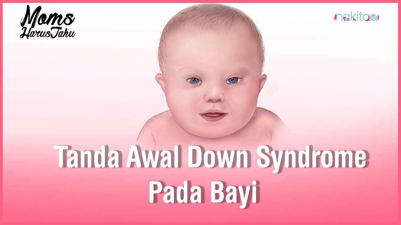 Gambar Bayi Down Syndrome - KibrisPDR