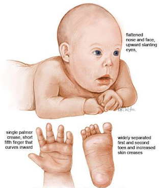 Detail Gambar Bayi Down Syndrome Nomer 14