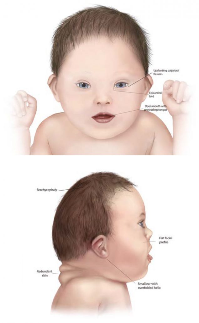 Detail Gambar Bayi Down Syndrome Nomer 23