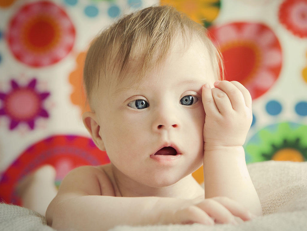 Detail Gambar Bayi Down Syndrome Nomer 24