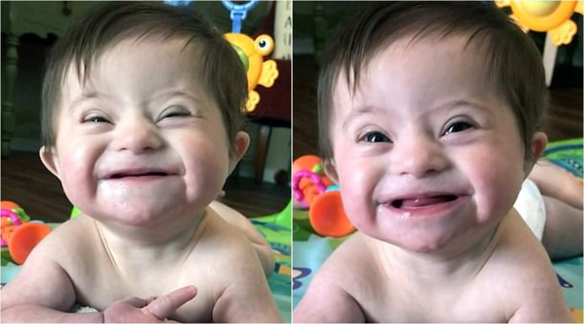 Detail Gambar Bayi Down Syndrome Nomer 34