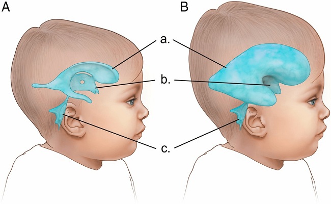 Detail Gambar Bayi Hidrosefalus Nomer 22