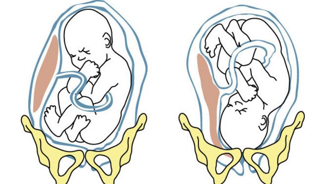 Detail Gambar Bayi Sungsang Nomer 43