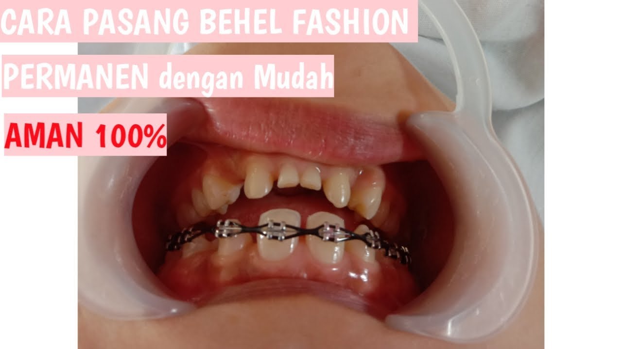 Detail Gambar Behel Fashion Nomer 37