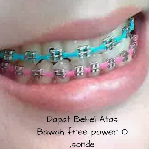 Detail Gambar Behel Gigi Atas Nomer 2
