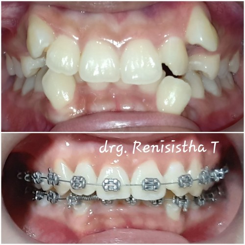 Detail Gambar Behel Gigi Atas Nomer 13