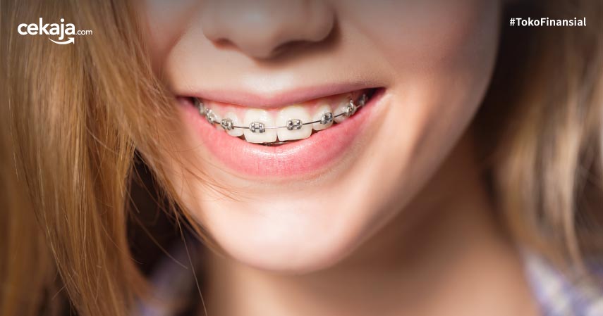 Detail Gambar Behel Gigi Atas Nomer 14
