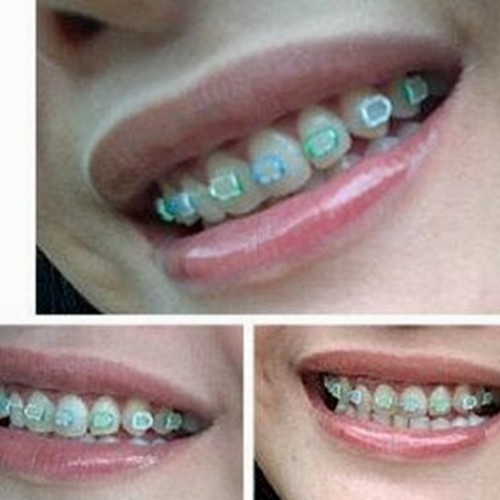 Detail Gambar Behel Gigi Atas Nomer 15