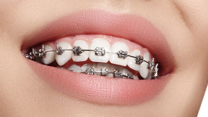 Detail Gambar Behel Gigi Atas Nomer 17