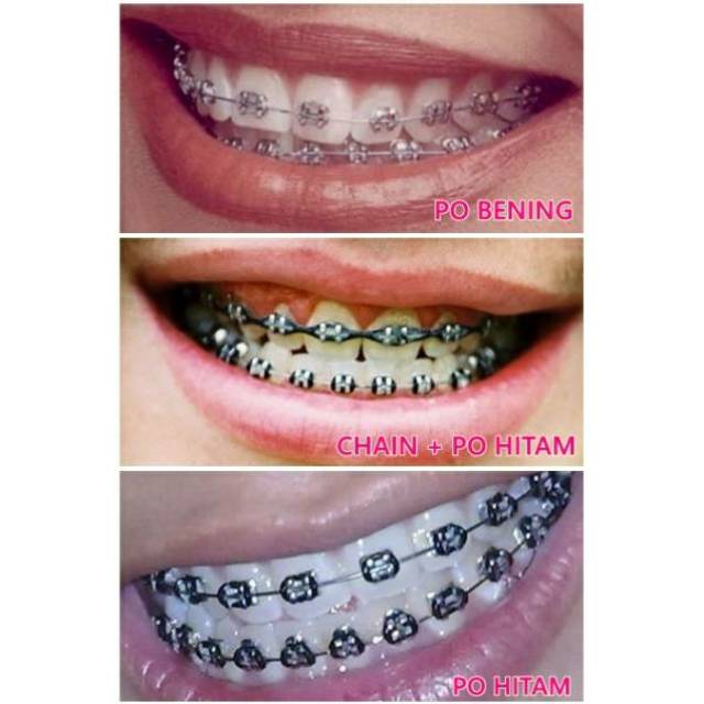 Detail Gambar Behel Gigi Atas Nomer 3
