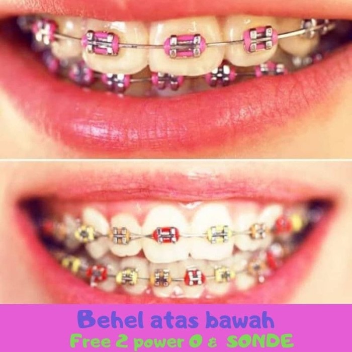 Detail Gambar Behel Gigi Atas Nomer 21