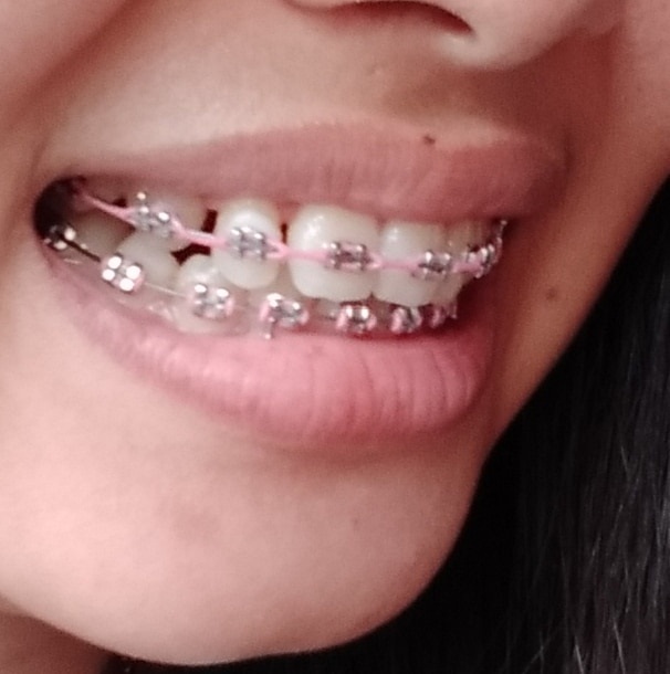 Detail Gambar Behel Gigi Atas Nomer 27