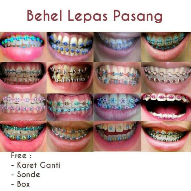 Detail Gambar Behel Gigi Atas Nomer 28
