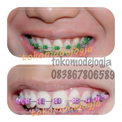 Detail Gambar Behel Gigi Atas Nomer 29