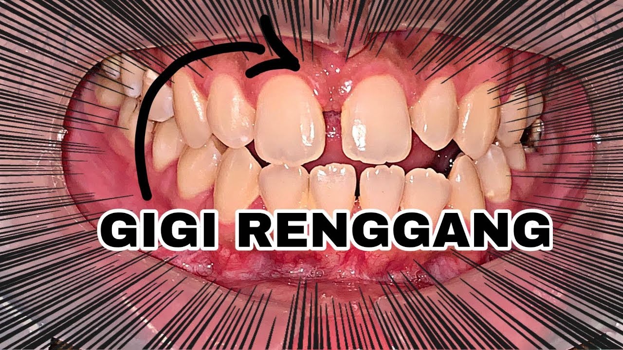 Detail Gambar Behel Gigi Atas Nomer 30