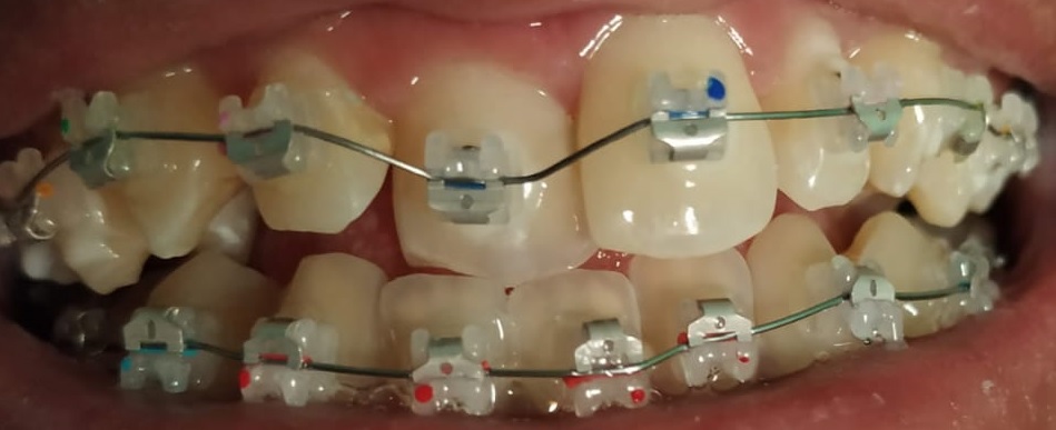 Detail Gambar Behel Gigi Atas Nomer 31