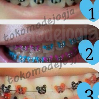 Detail Gambar Behel Gigi Atas Nomer 33