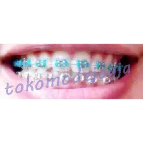 Detail Gambar Behel Gigi Atas Nomer 34