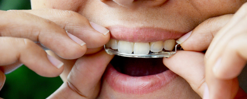 Detail Gambar Behel Gigi Atas Nomer 35