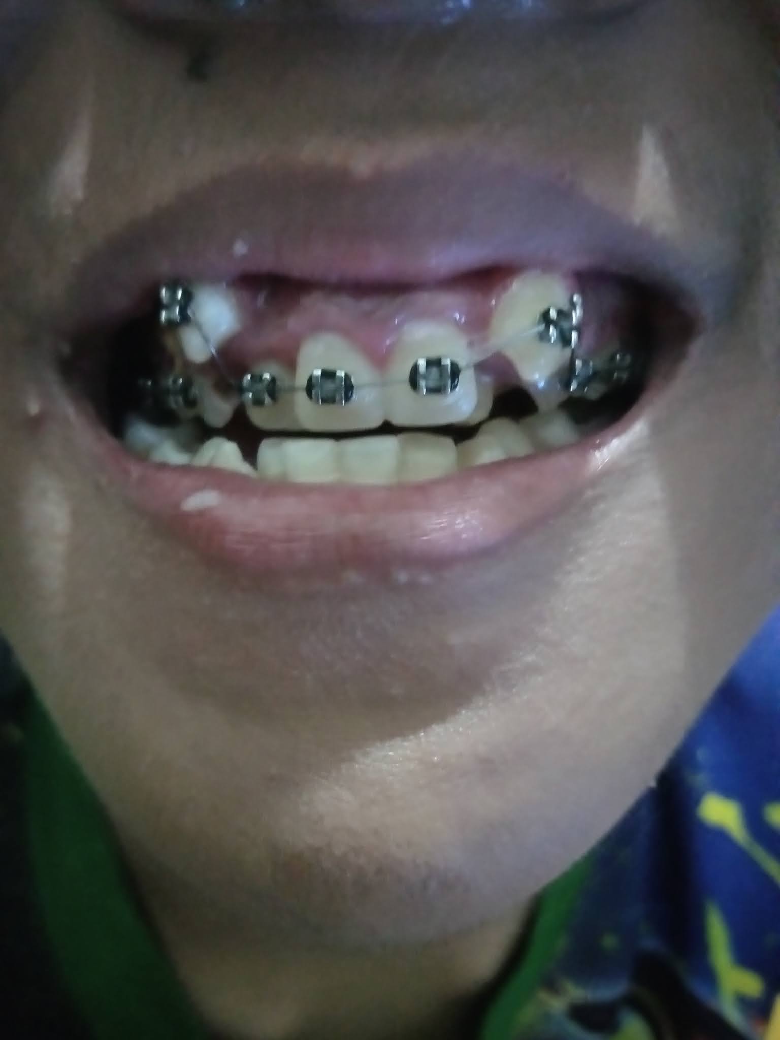 Detail Gambar Behel Gigi Atas Nomer 36