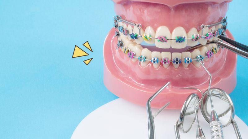 Detail Gambar Behel Gigi Atas Nomer 37