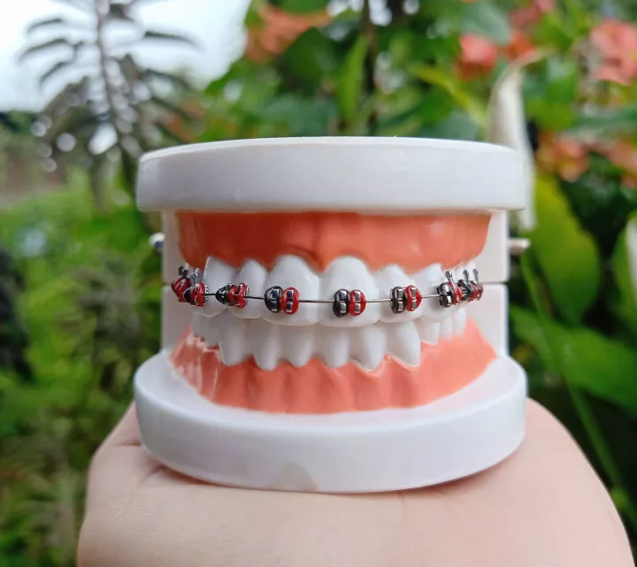 Detail Gambar Behel Gigi Atas Nomer 5