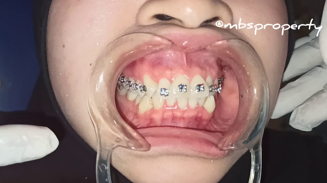 Detail Gambar Behel Gigi Atas Nomer 40