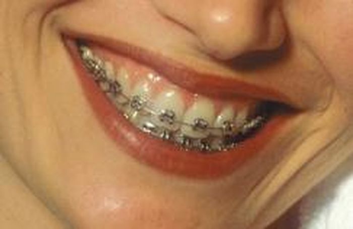Detail Gambar Behel Gigi Atas Nomer 43