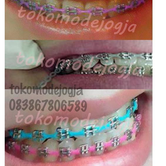 Detail Gambar Behel Gigi Atas Nomer 49