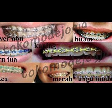 Detail Gambar Behel Gigi Atas Nomer 50