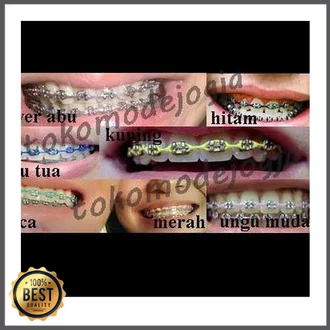 Detail Gambar Behel Gigi Atas Nomer 51