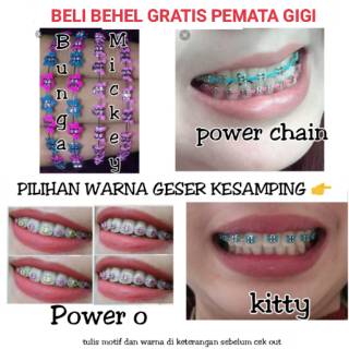 Detail Gambar Behel Gigi Atas Nomer 54