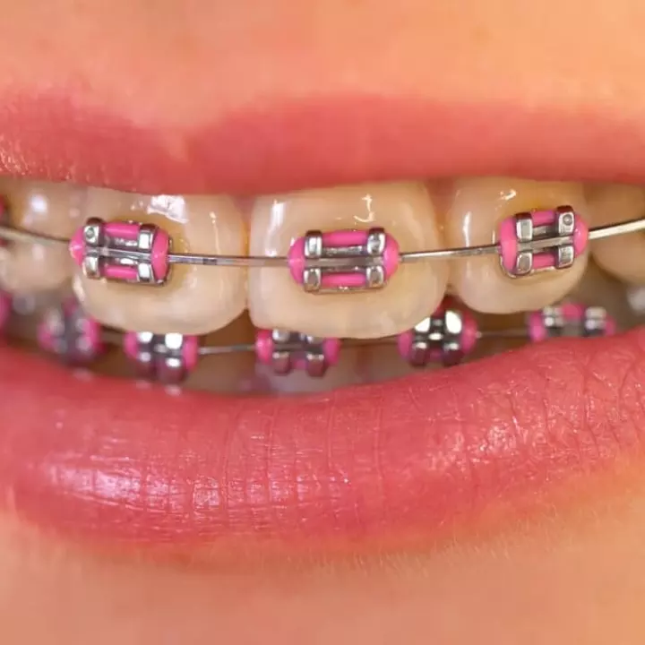 Detail Gambar Behel Gigi Atas Nomer 55