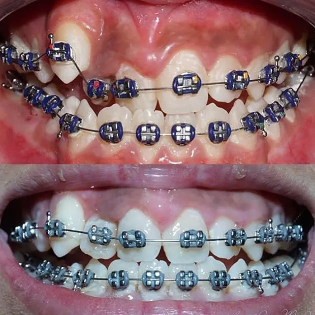 Detail Gambar Behel Gigi Atas Nomer 56