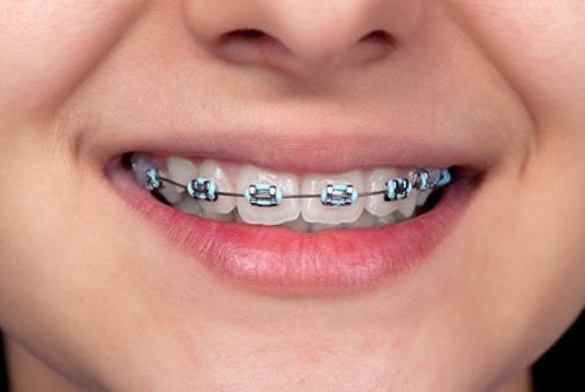 Detail Gambar Behel Gigi Atas Nomer 8