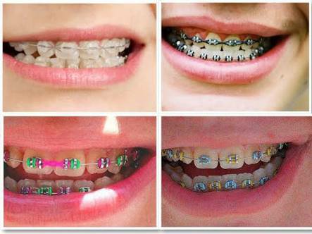 Detail Gambar Behel Gigi Atas Nomer 10