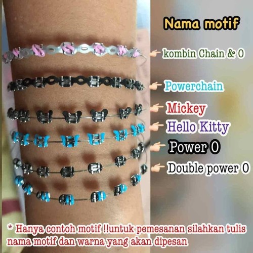 Gambar Behel Lepas Pasang - KibrisPDR
